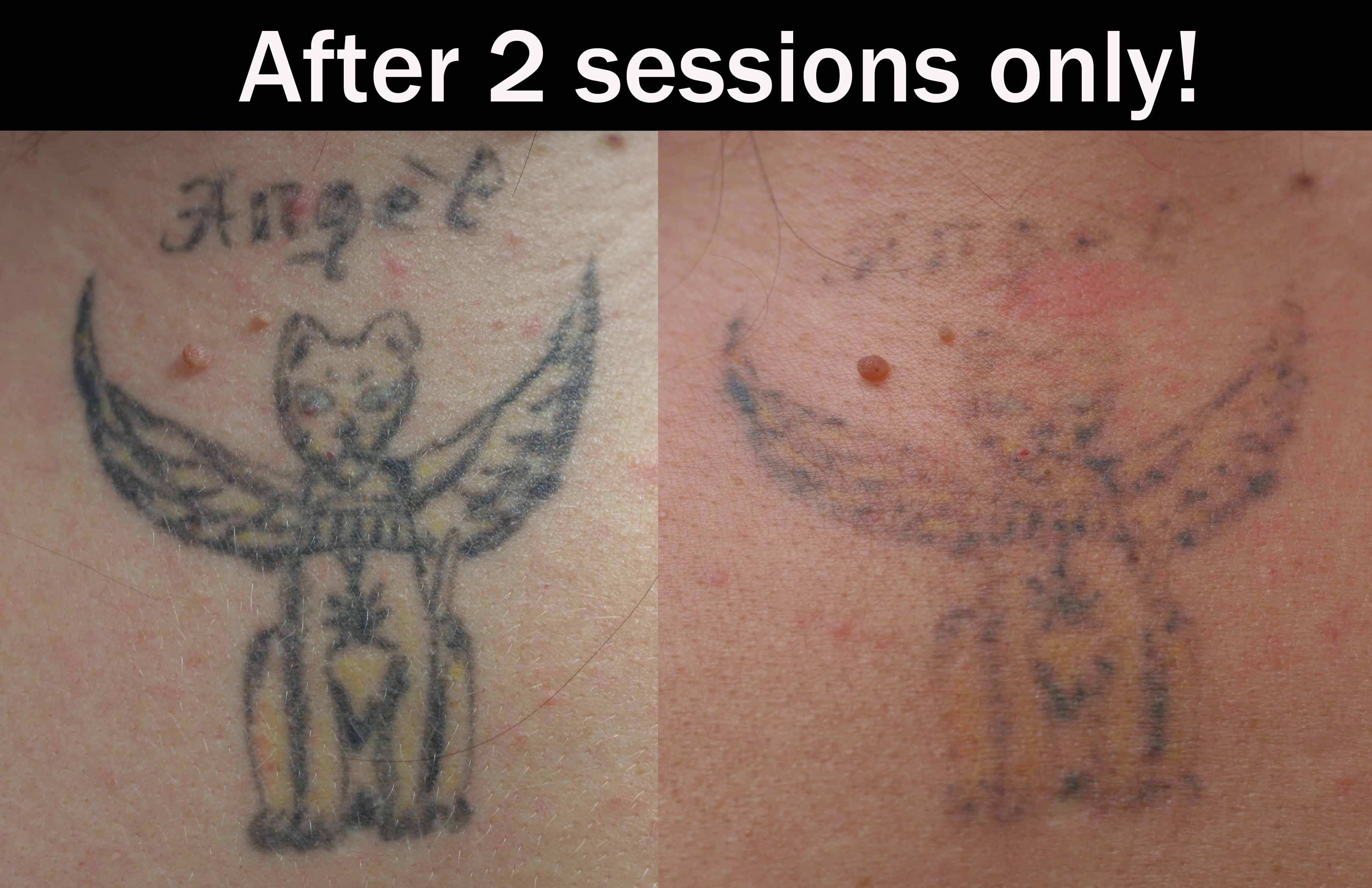 Laser-tattoo-removal-2-sessions | Tattoo Love