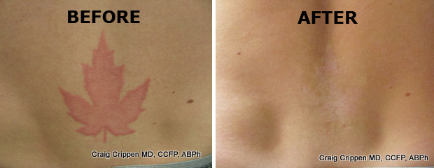 laser-tattoo-removal-before-and-after.jpg