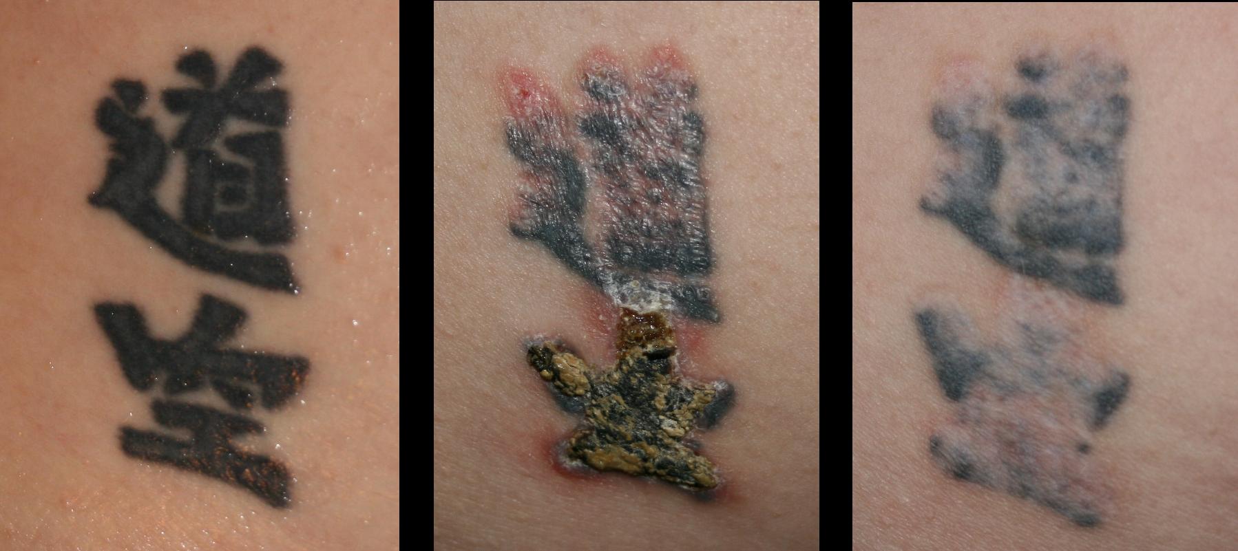 100+ [ Laser Tattoo Removal Durham ] | Tattoo Removal Faq ...