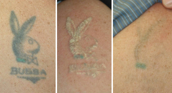 ... Tattoo Cream | affordable tattoo removal | best laser tattoo removal